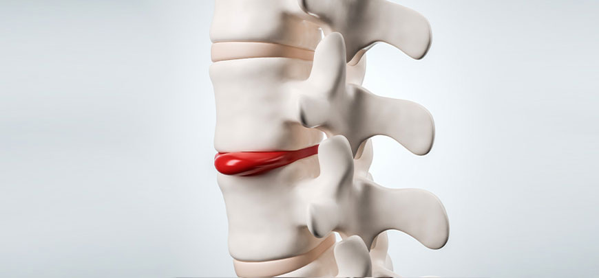 patient receiving herniated disc treatment in San Clemente CA