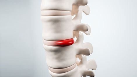 patient requiring disc Injuries treatment in San Clemente CA
