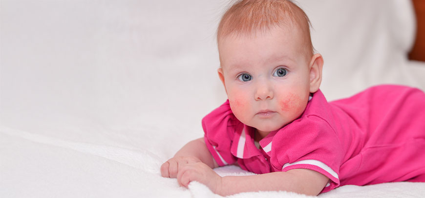 patient needing Eczema treatment in San Clemente CA