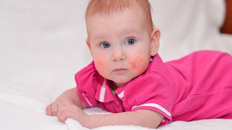 patient requiring eczema treatment in San Clemente CA