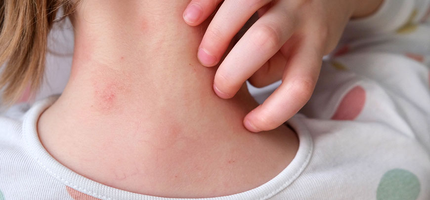 patient needing Frequent Rashes treatment in San Clemente CA